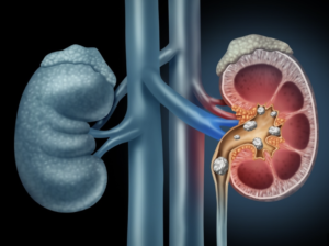 Conheça as Principais Causas dos Cálculos Renais