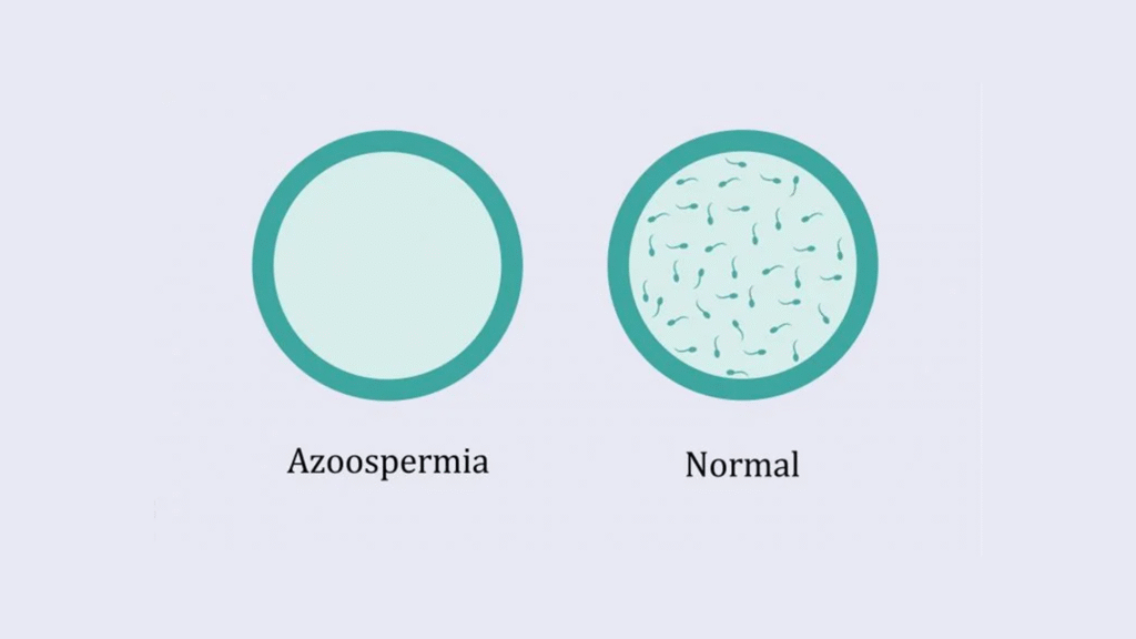O que é azoospermia e quais são as opções de tratamento