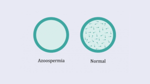 O que é azoospermia e quais são as opções de tratamento